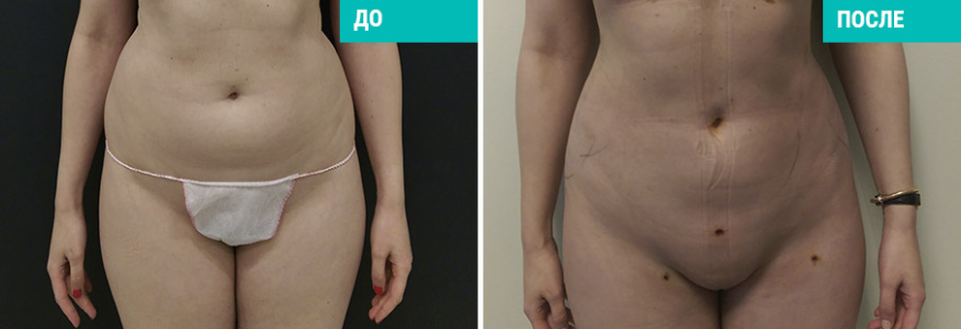 Вейзер липосакция