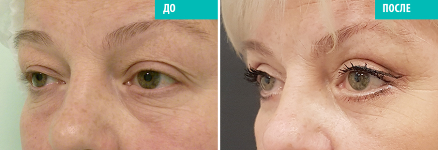 Блефаропластика