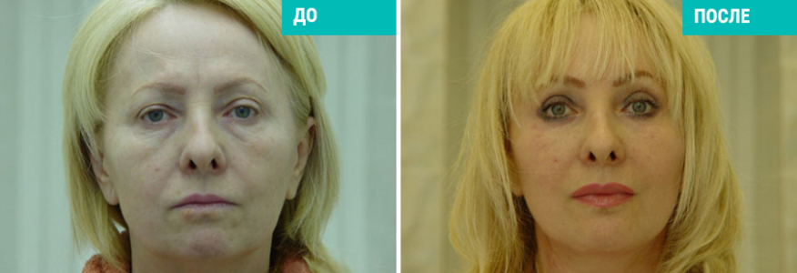 Фейслифтинг