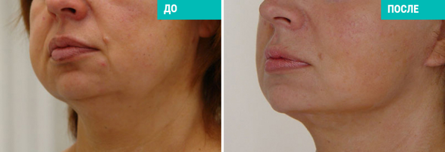 Фейслифтинг