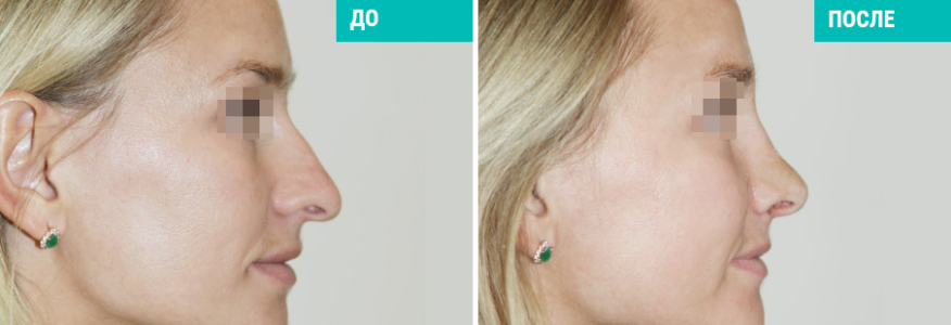 Ринопластика