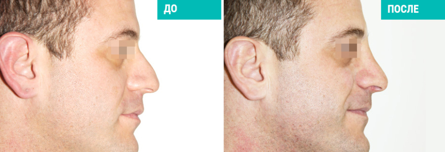 Ринопластика