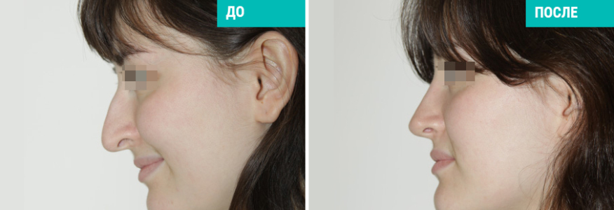 Ринопластика