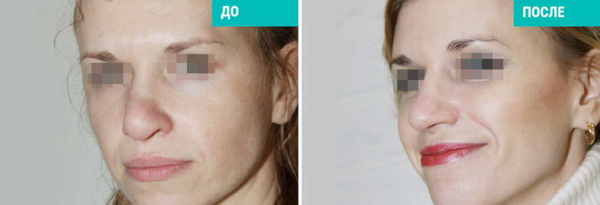 Ринопластика