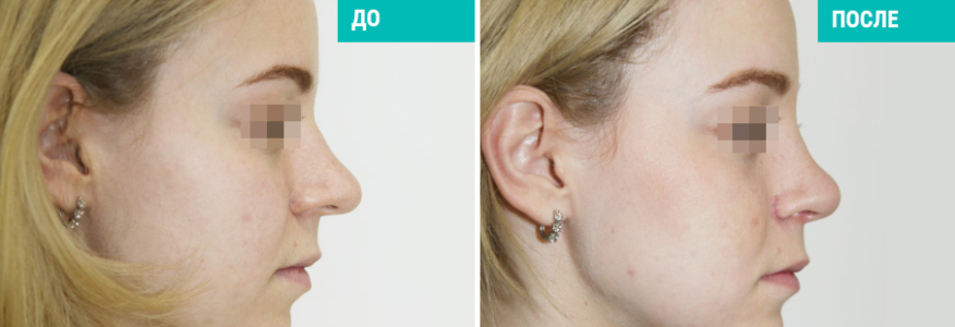 Ринопластика