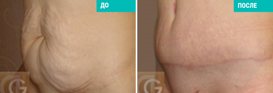 Абдоминопластика