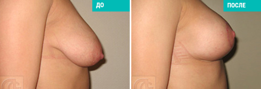 Подтяжка груди