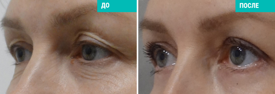 Блефаропластика