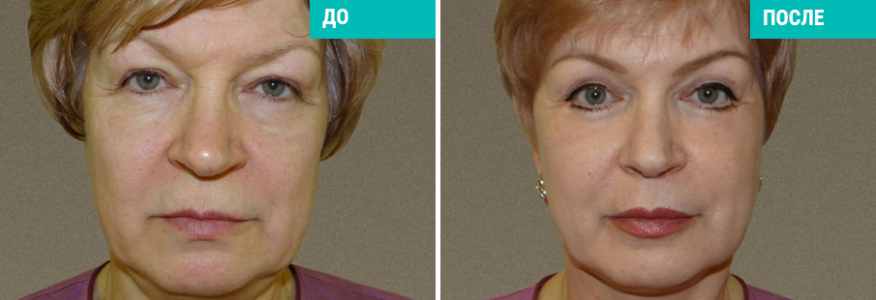 Подтяжка шеи