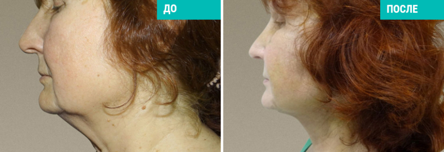 Подтяжка шеи