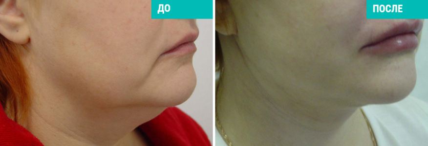 Подтяжка шеи