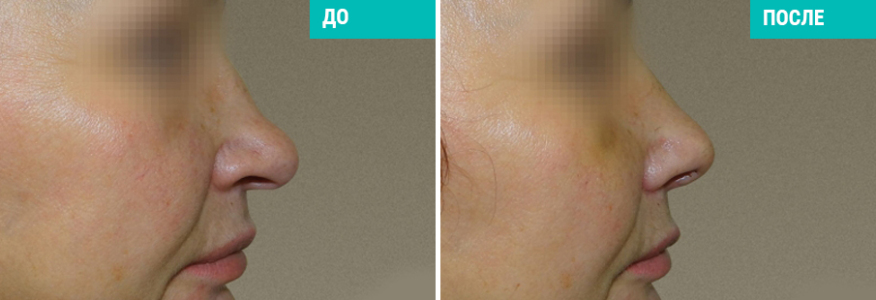 Ринопластика