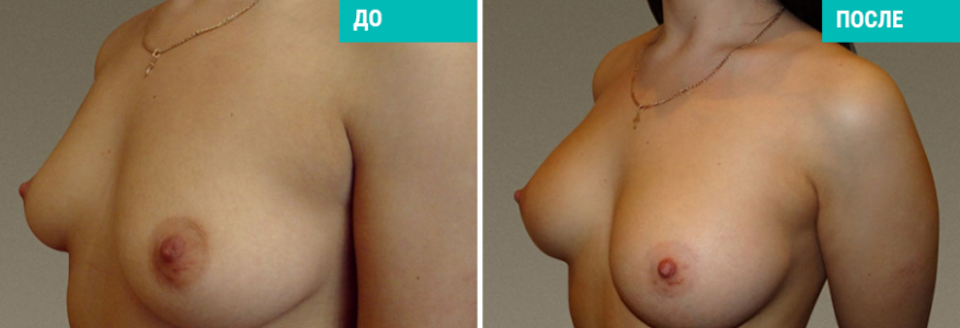 Увеличение груди