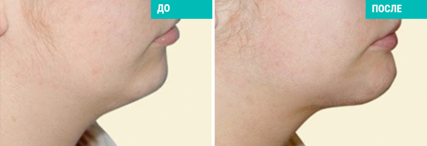 Ментопластика