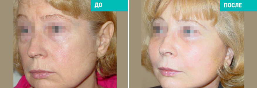 Пластика лица