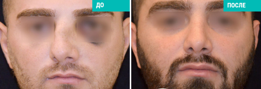 Ринопластика