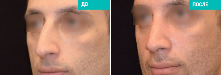 Ринопластика