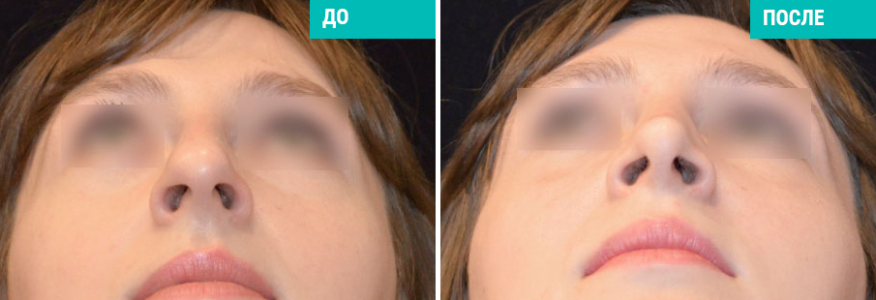 Ринопластика