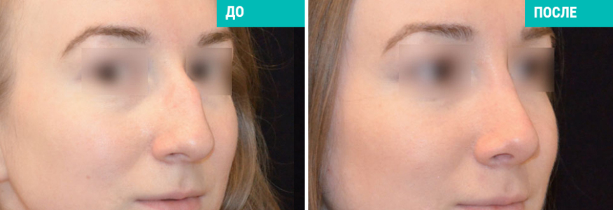 Ринопластика