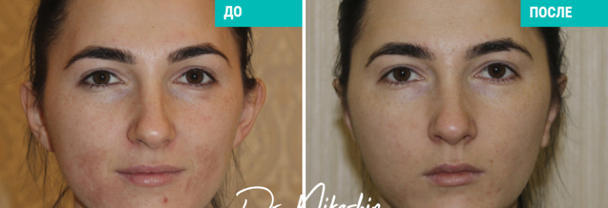 Отопластика