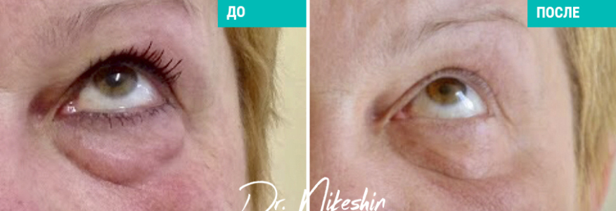 Трансконьюктивальная пластика нижних век ( операция проведена лазерным скальпелем) 