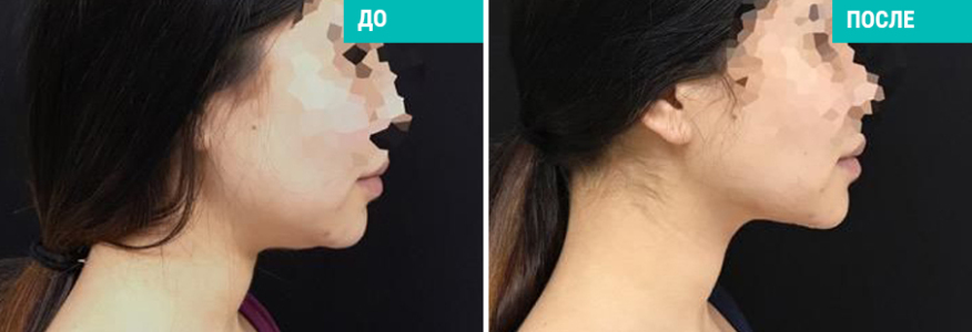 Липосакция второго подбородка