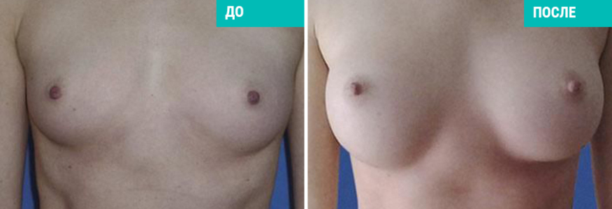 Увеличение груди