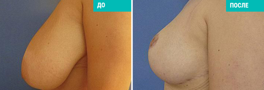 Уменьшение груди