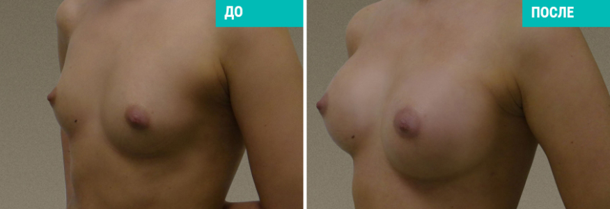 Увеличение груди