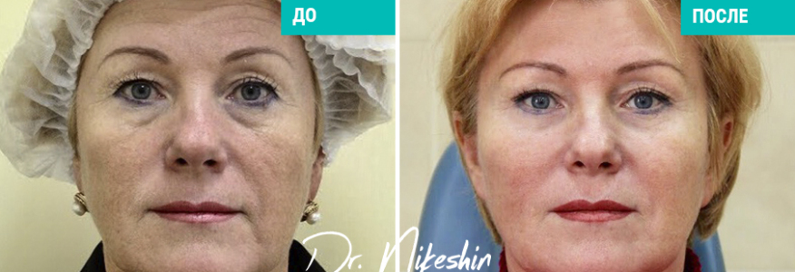 Эндоскопический лифтинг лоб, виски, средняя зона 
