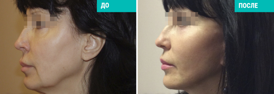 Triple S-lifting (3S-лифтинг)