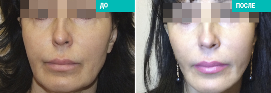 Triple S-lifting (3S-лифтинг)