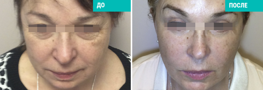 Triple S-lifting (3S-лифтинг)