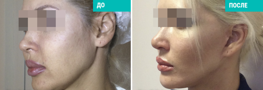 PRIMA-лифтинг