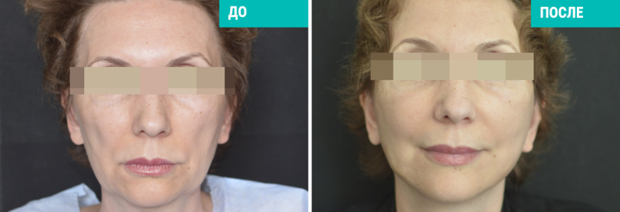 SMAS-лифт и пластика шеи