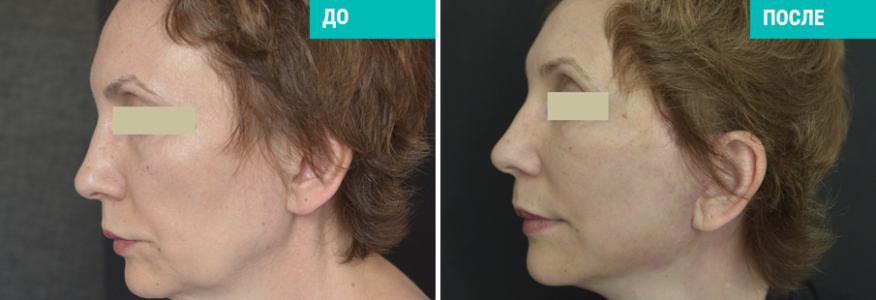 SMAS-лифт и пластика шеи