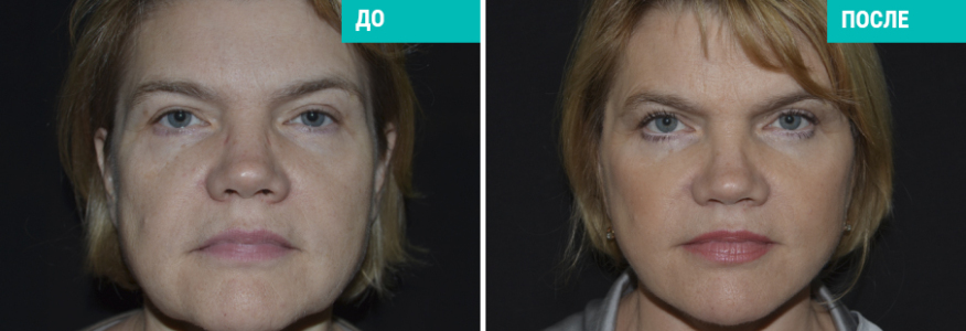 SMAS-лифтинг с укороченным рубцом