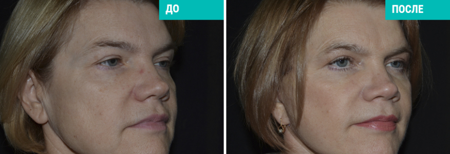 SMAS-лифтинг с укороченным рубцом