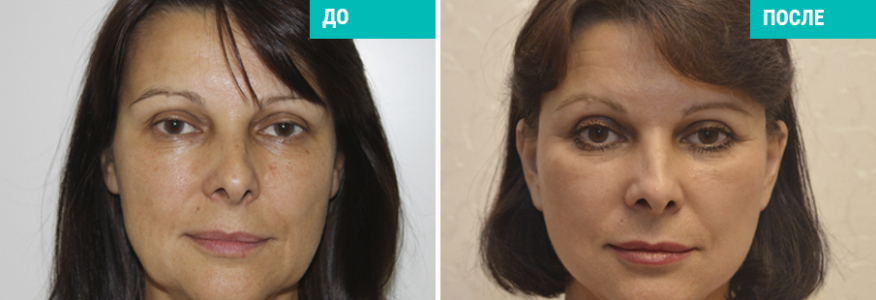 Пластика лица