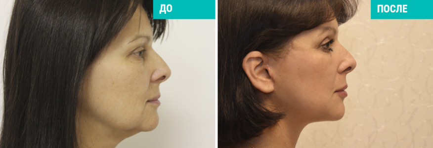 Пластика лица