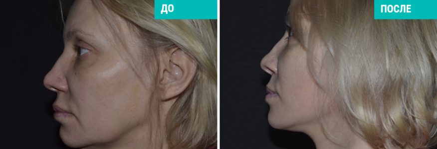 SMAS-лифтинг с укороченным рубцом