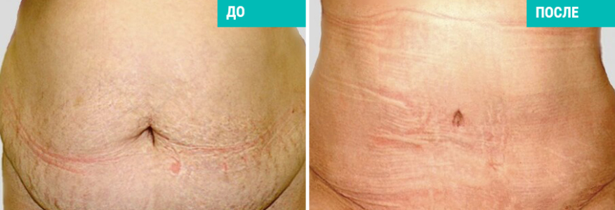 Абдоминопластика