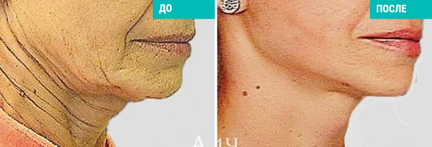 Коррекция шеи и подбородка