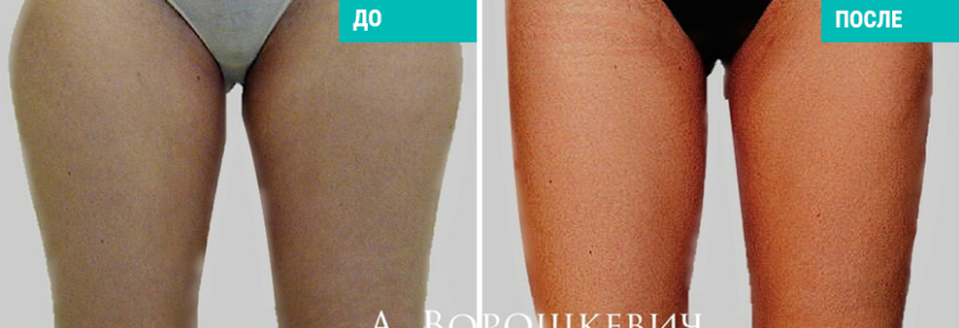 Липосакция 