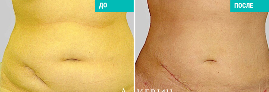 Липосакция 