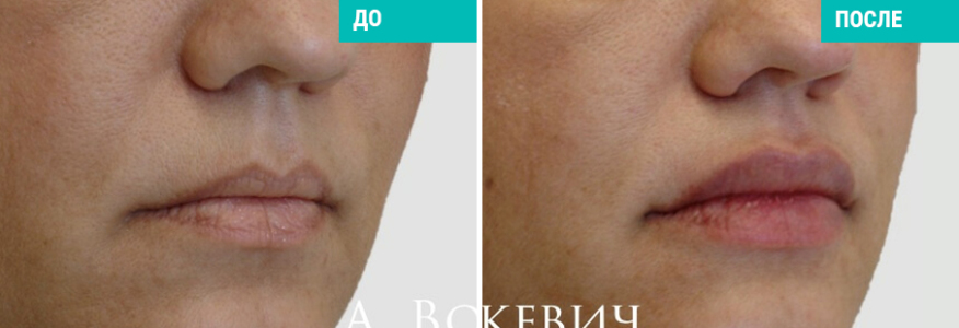 Липофилинг