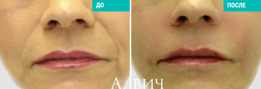 Липофилинг