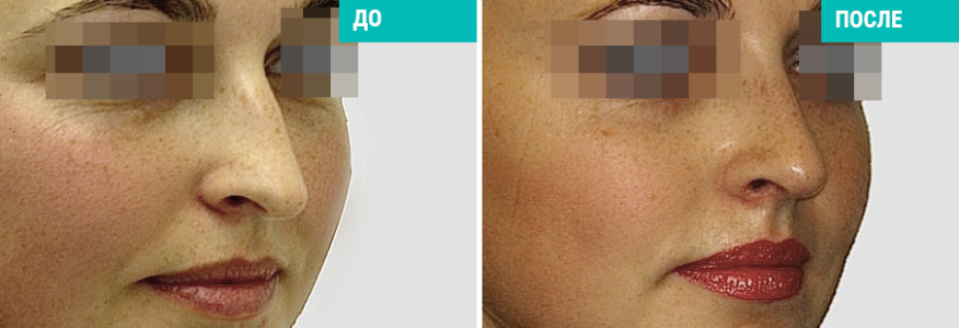 Ринопластика