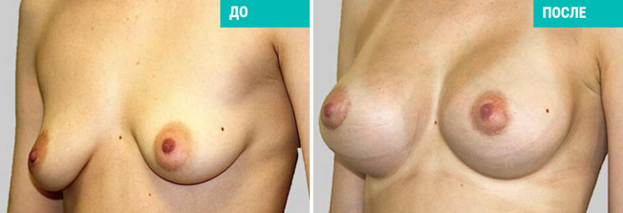 Увеличение груди