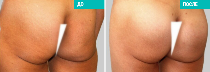 Увеличение ягодиц